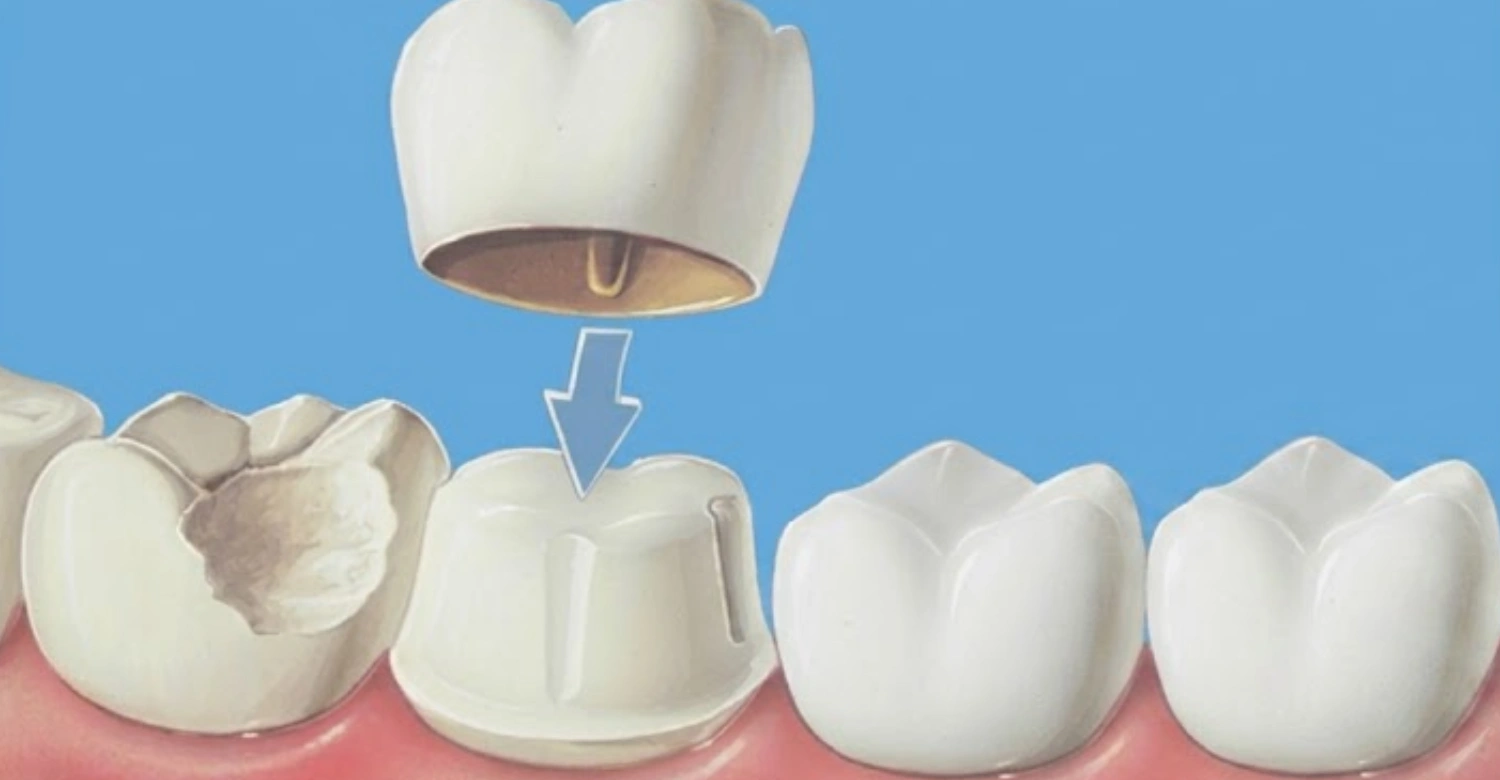 Crown After Root Canal Inblog